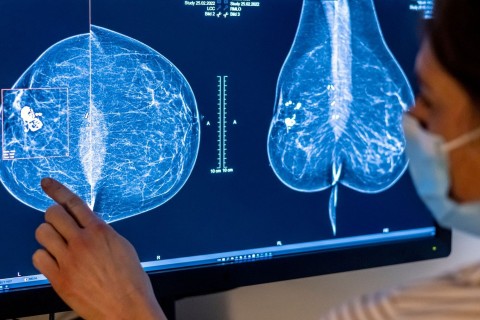 Brustkrebs-Früherkennung wird ausgeweitet