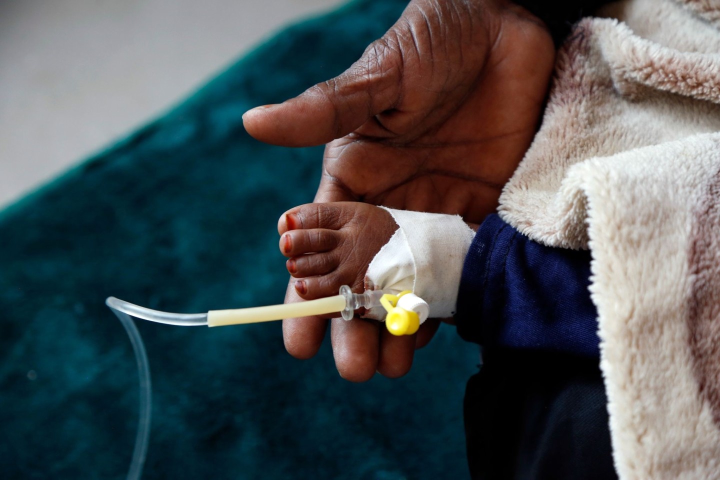 Ein mit Cholera infiziertes Kind erhält eine medizinische Behandlung.
