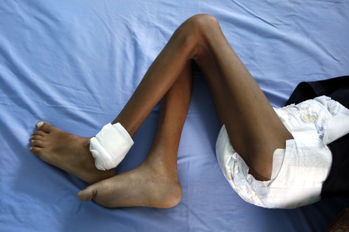 Ein unterernährtes Kind liegt in einem Krankenhaus im Jemen. Einer Studie zufolge könnte ein regionaler Atomkrieg weltweit Hungersnöte auslösen.