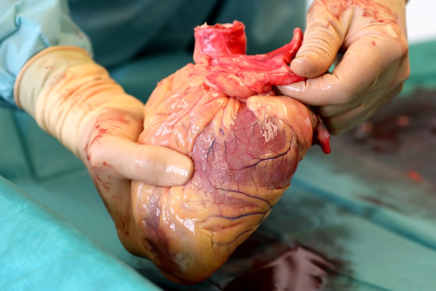 Ein Transplantationsmediziner hält das Herz eines Verstorbenen in den Händen, das kurz zuvor entnommen wurde.